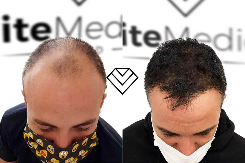 Antes y Después del Implante Capilar FUE Zafiro en Élite Medical Madrid