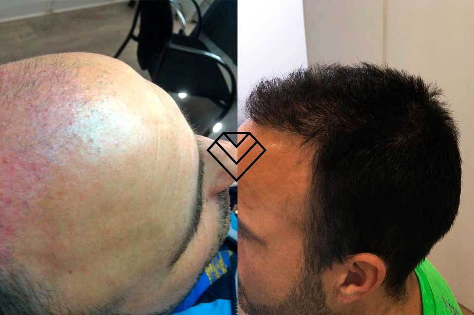 Antes y Después del Implante Capilar FUE Zafiro en Élite Medical Madrid